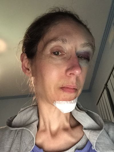 My bicycling accident injuries, 12/5/2020